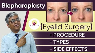 💹What is Blepharoplasty or Eyelid in Hindi?💹 Upper And Lower Blepharoplasty / Eyelid