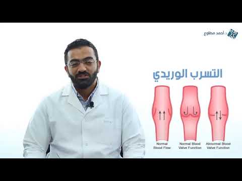 كل شئ عن التسرب الوريدي مع الدكتور احمد مطاوع