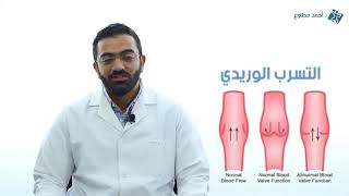 كل شئ عن التسرب الوريدي مع الدكتور احمد مطاوع
