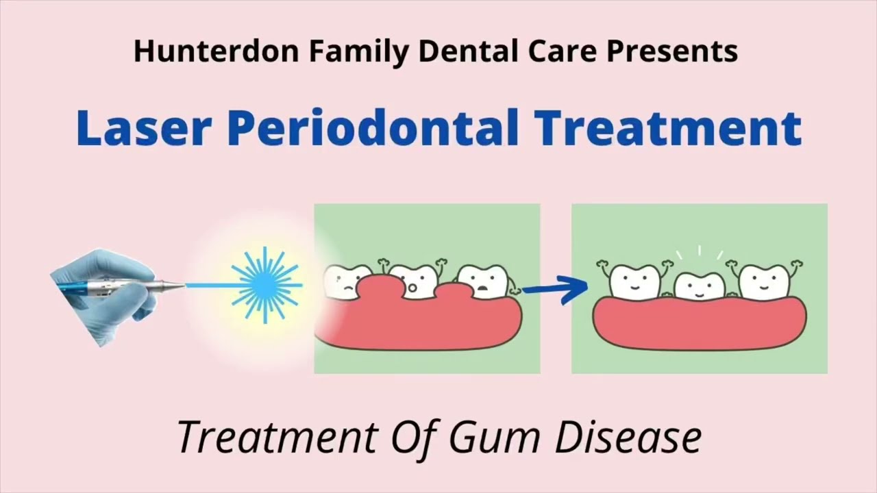 Laser Treatment of Periodontal Disease