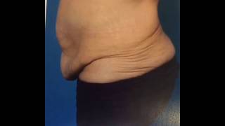 Tummy Tuck Before and After - Dr. Anthony Youn