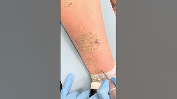 XÓA HÌNH XĂM AN TOÀN, HIỆU QUẢ BẰNG LASER PICOSURE HIỆN ĐẠI 2023 l THẨM MỸ RIO #shorts #thẩm_mỹ_rio