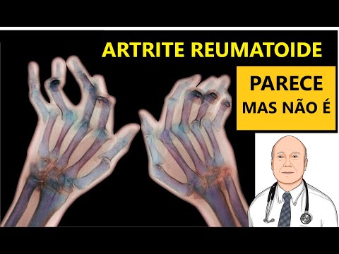 Vídeo: É Assim Que A Artrite Reumatóide Se Parece