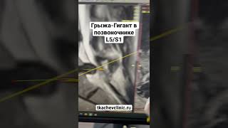 Грыжа-гигант в позвоночнике, L5-S1. #грыжадиска #позвоночник