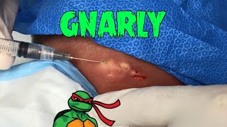 Gnarly Neck Abscess