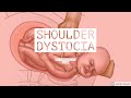 SHOULDER DYSTOCIA(Unit-8 OBG- Abnormal Labour)