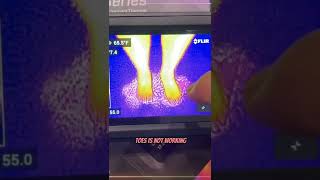 Determine if you have Neuropathy using Flir Thermal Camera
