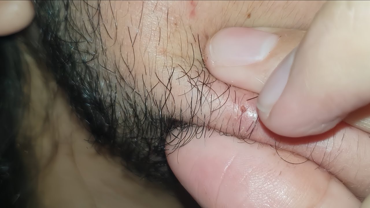 Under Ingrown hair treatment | asmr beard satisfying | Massage therapy 