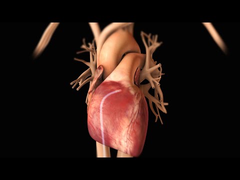 Cardiac Arrhythmia