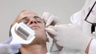 Dr. Alan Durkin Testing Radiesse Injection On Male Oceandriveplasticsurgery