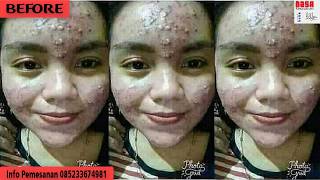 085233674981 Obat untuk Jerawat