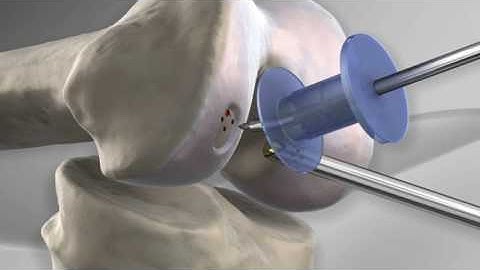 Microfracture with Arthrex® PowerPick™