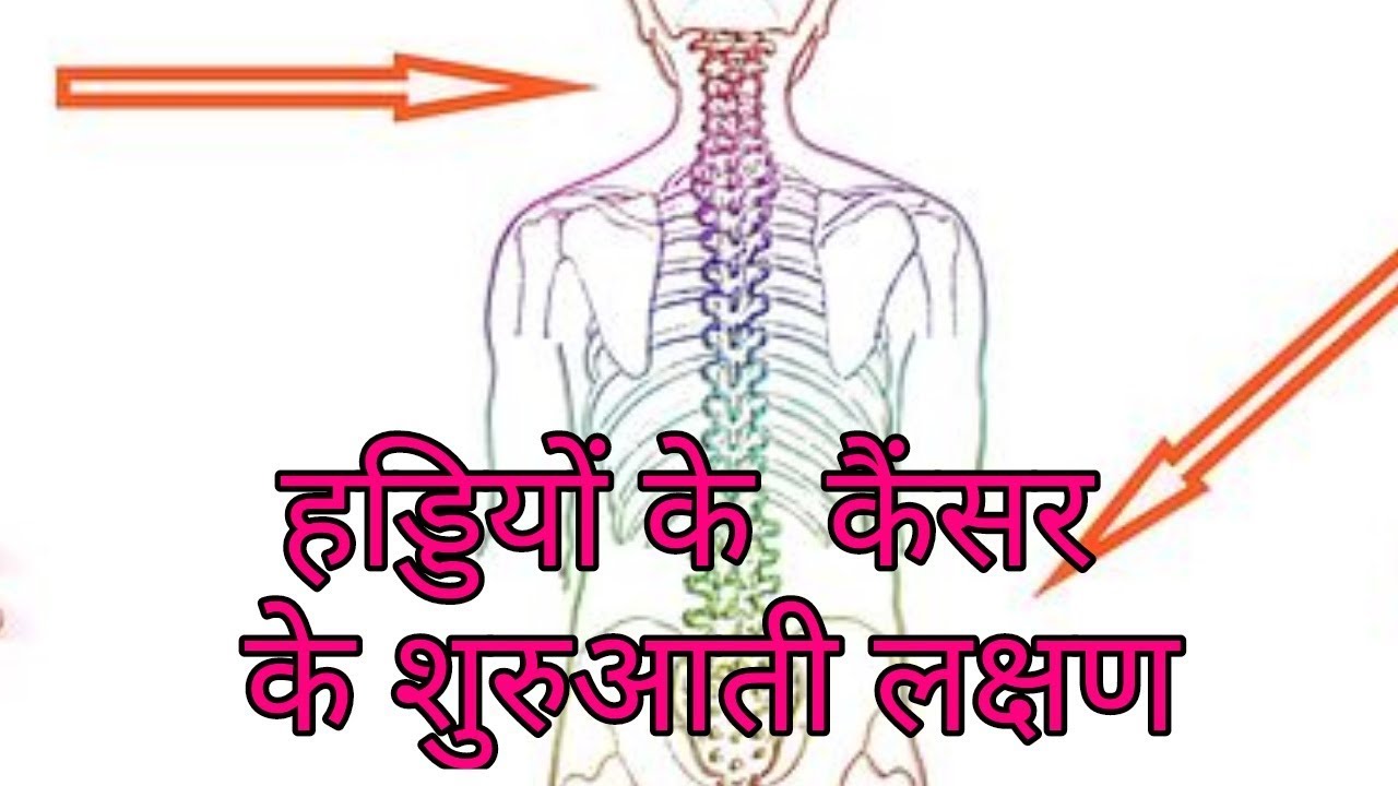 हड्डियों के कैंसर के लक्षण,haddi ke cancer ke lakshan,bone cancer