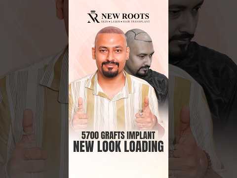 5700 Grafts Hair Transplant in Kolkata | Cost and Details #hairtransplant #kolkata #shorts