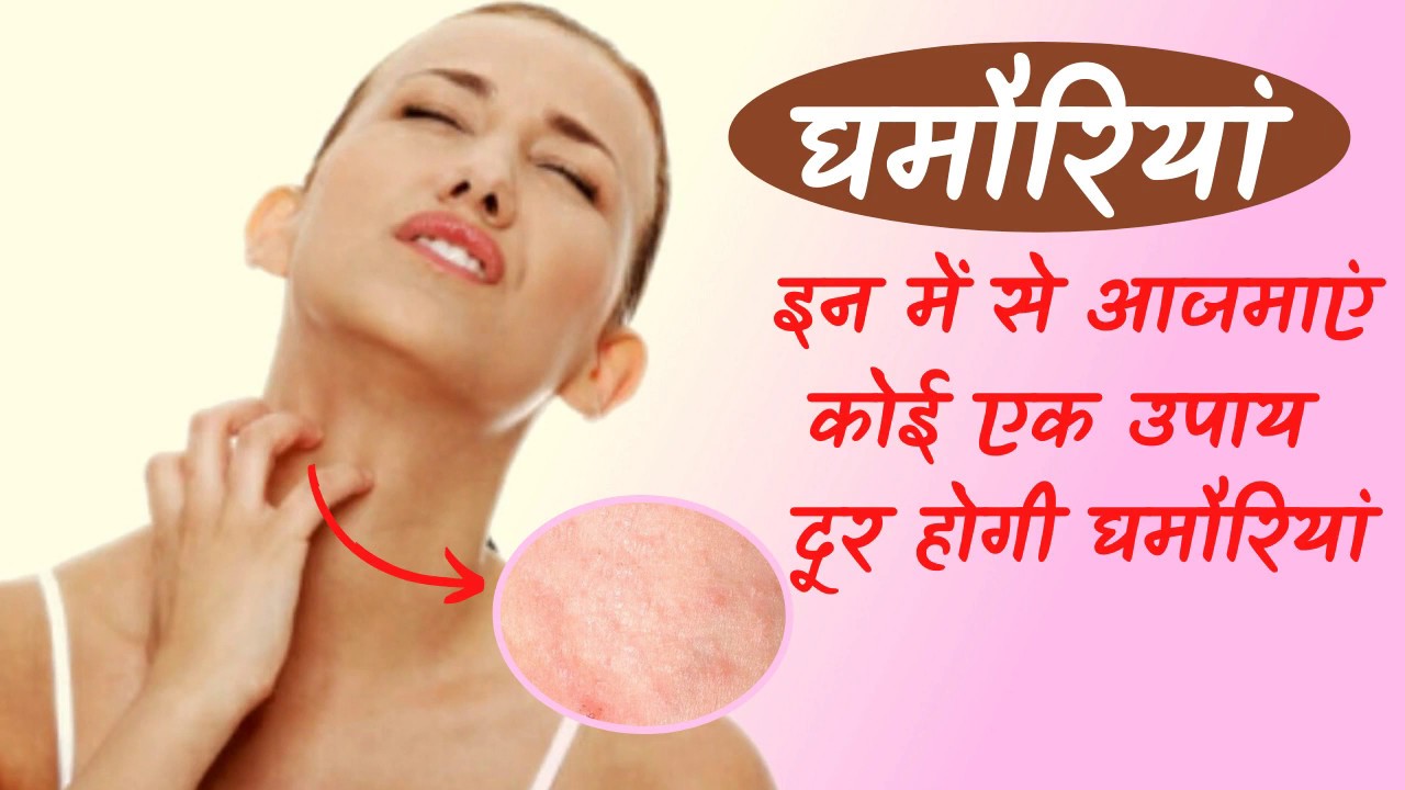 Ghamoriya Dur Karne Ke Upay | Tips To Cure Prickly Heat Rashes | Heat Rashes - YouTube