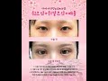 #더비비성형외과 어느 각도에서도 자신 있는 눈매의 완성