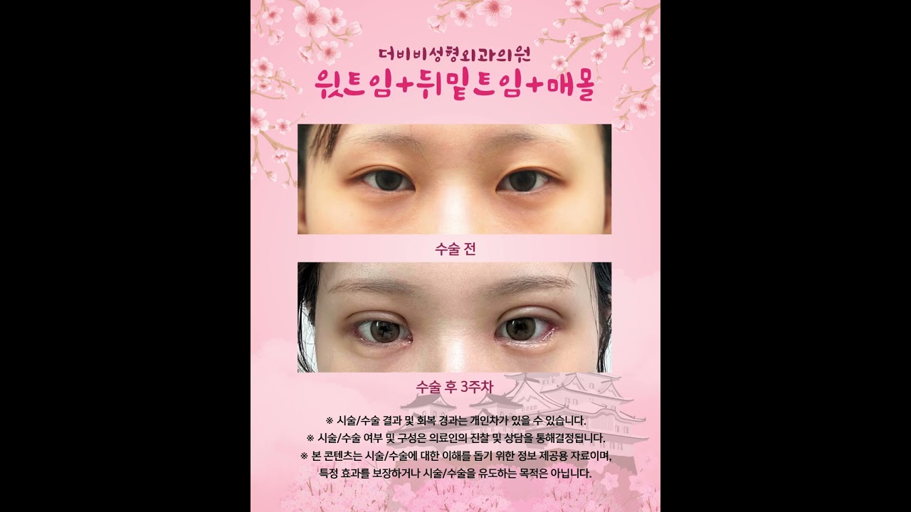 #더비비성형외과 어느 각도에서도 자신 있는 눈매의 완성