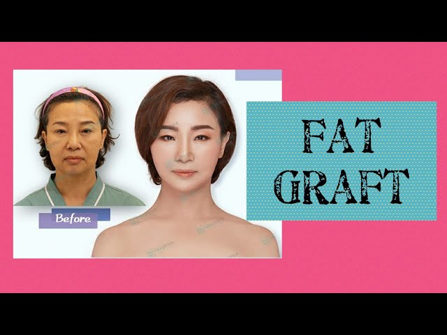 Fat Graft | Olivia Rachelina Hans class=