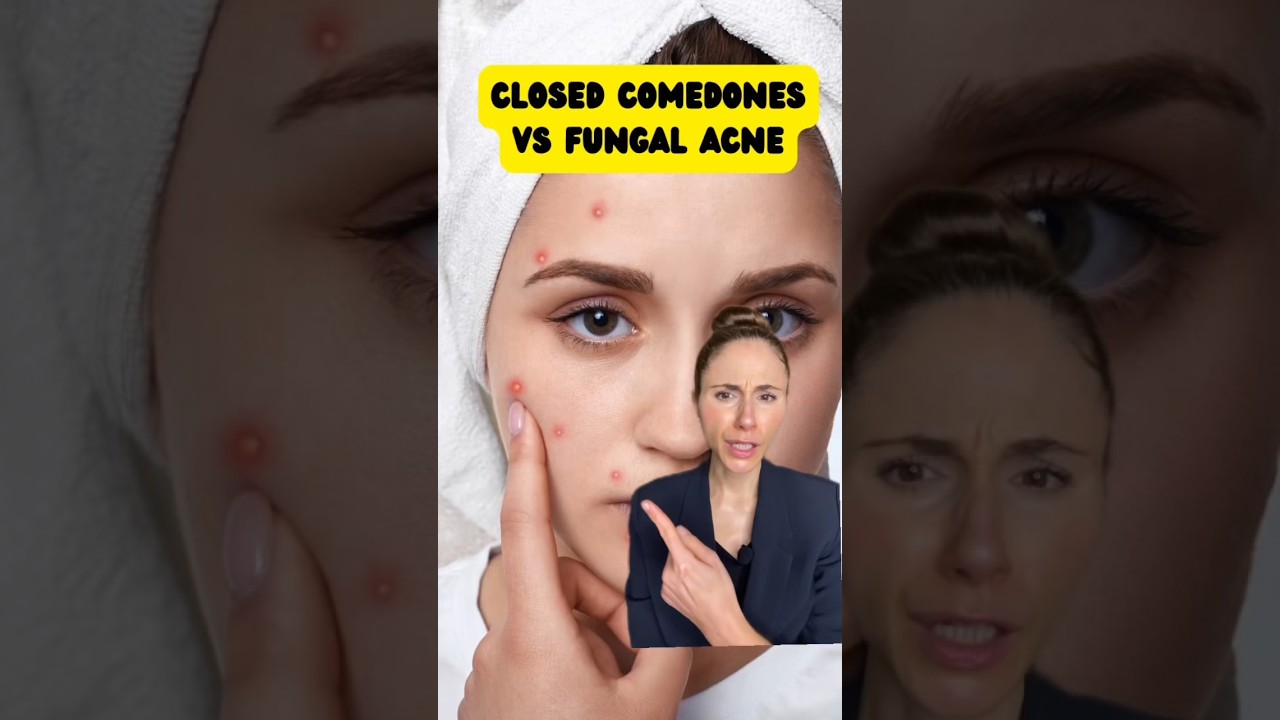 What Is The Difference Between Closed Comedones And Fungal Acne? #dermatologist