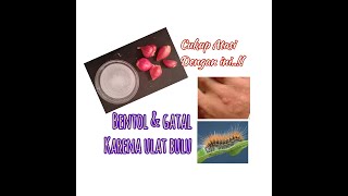 Cara Mengatasi Gatal/Bentol Akibat Ulat Bulu