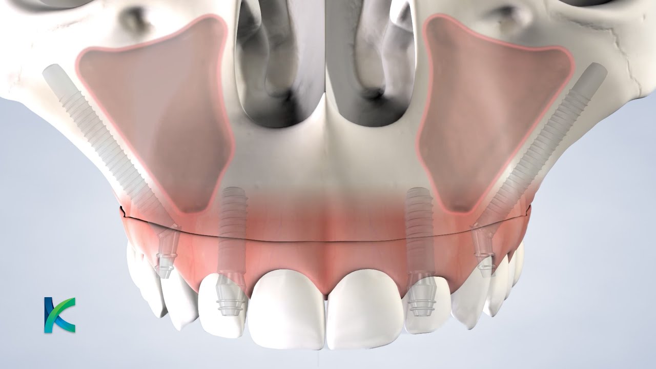 Zygomatic Dental Implants in Louisville, KY