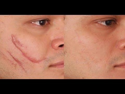 Video: 3 formas sencillas de curar las marcas de arañazos en la cara