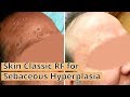 Skin classic rf for sebaceous hyperplasia at reflections center in nj