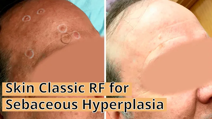 Skin Classic RF for Sebaceous Hyperplasia at Reflections Center in NJ