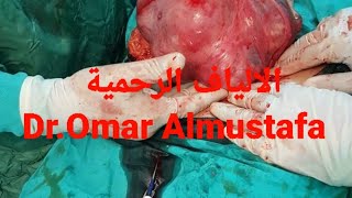 الألياف الرحمية عند النساء fibromatozis  Dr.Omar Almustafa