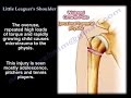 Little Leaguer's Shoulder - Everything You Need To Know - Dr. Nabil Ebraheim