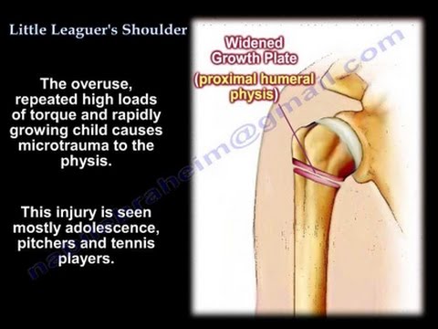 Little Leaguer S Shoulder Everything You Need To Know Dr Nabil Ebraheim Youtube Little Leaguer S Shoulder Everything You Need To Know Dr Nabil Ebraheim Youtube