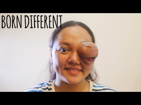 I Lost My Eye To A Tumour | BORN DIFFERENT