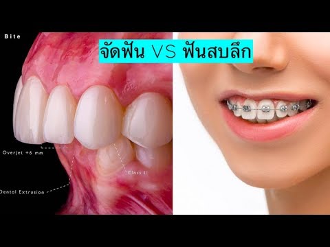 จัดฟัน การแก้ไขปัญหาฟันสบลึก (deep bite)