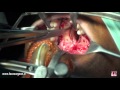 Palatal Fistula closure