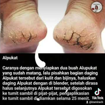 cara  mengobati tumit pecah pecah