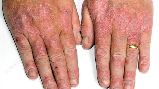 How To Treat Psoriasis on Hands