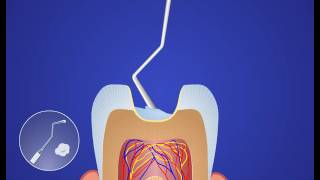 видео Лечение среднего кариеса в Москве