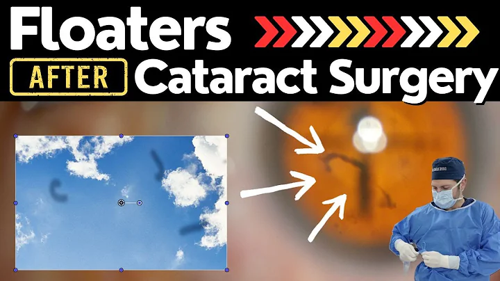 Cataracts & Floaters