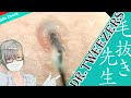 283 [200x Zoom] Revenue is low and difficult to continue Dr. tweezers 毛抜き先生の角栓や毛根