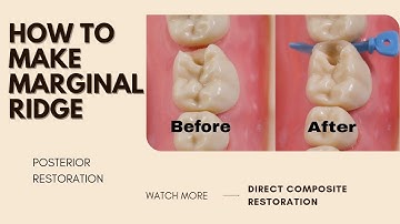 How to make marginal ridge | Direct Composite Restoration | Your Dentist #composite