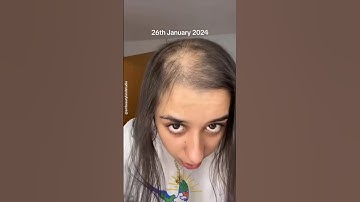 🔥30 Days Hair Growth Challenge 😱 | Hair Growth Tips ✅ #shorts #youtubeshorts Smbeautylandstudio