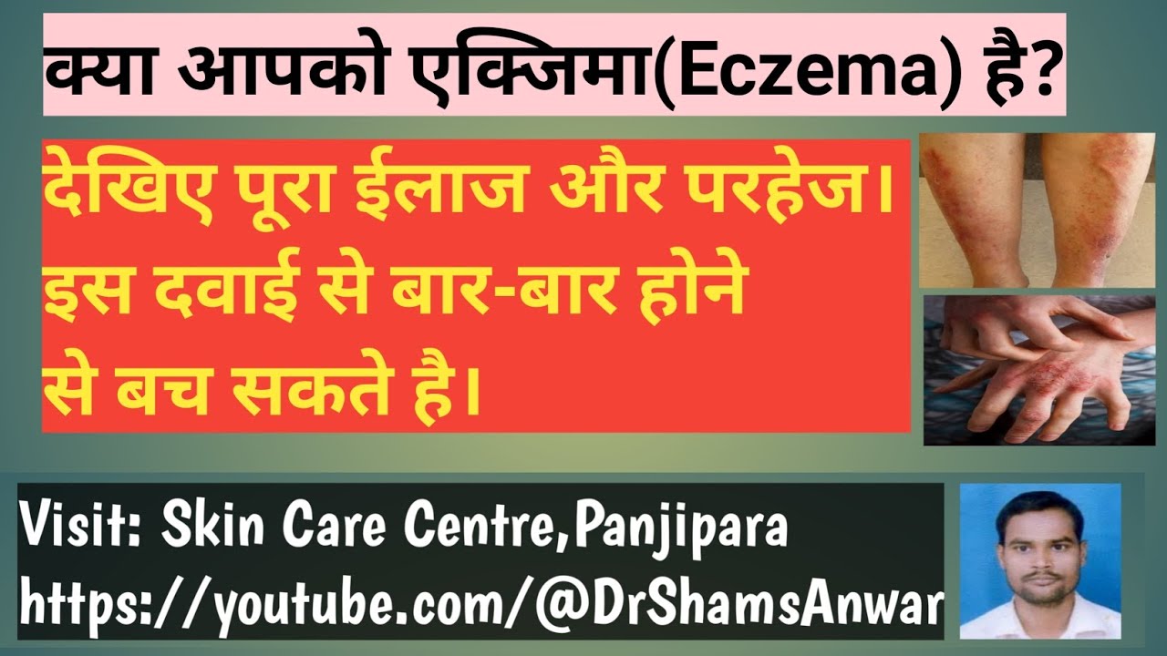 Eczema ka best treatment एक्जिमा का इलाज और परहेज।eczema 