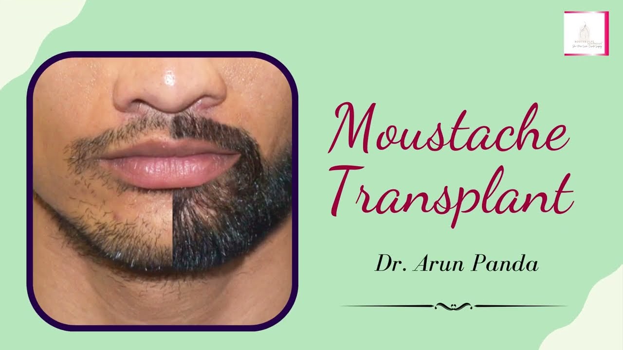 Moustache Transplant | What is beard balding ? How are beard or moustache transplants performed ?