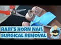 PERMANENT REMOVAL OF A DEFORMED NAIL (RAM'S HORN)