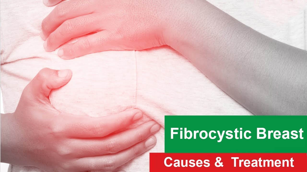 Fibrocystic Breast I Causes I Treatment I Changes Youtube