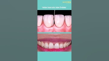 Trám tam giác đen ở răng - Nha Khoa Quốc Tế KAIYEN