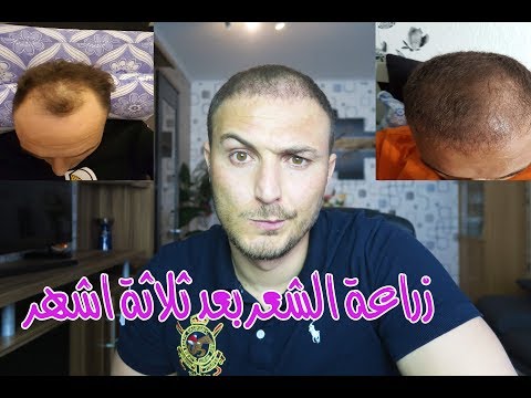ثلاثة اشهر بعد زراعة الشعر في المانيا    3  والرد ع بعض التعليقات