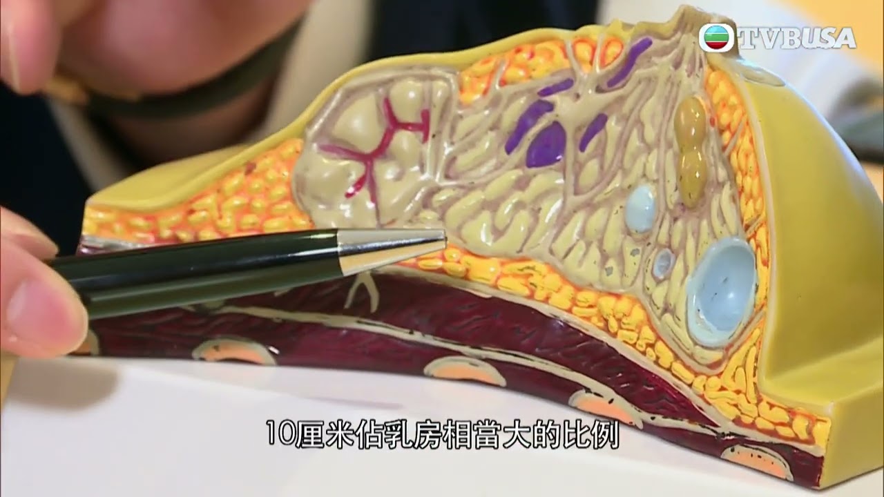 東張西望｜一名女子乳房發現細小組織，豈料進行微創手術後竟發現自己大半邊乳房被切去！詳情怎樣？