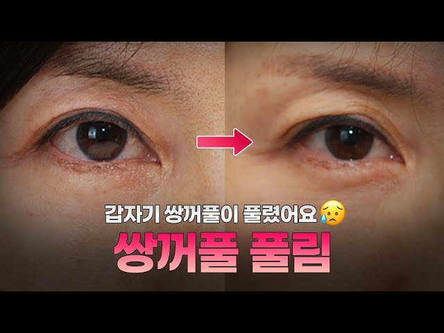 수술한 쌍꺼풀이 풀리는 이유는? | 압구정김원장