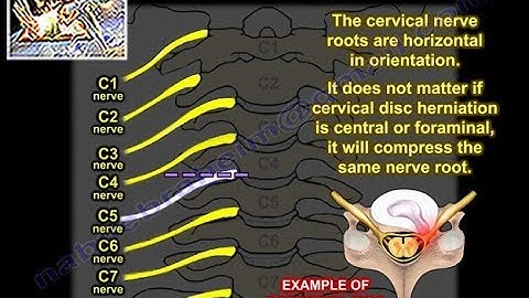 Cervical Radiculopathy - Everything You Need To Know - Dr. Nabil Ebraheim